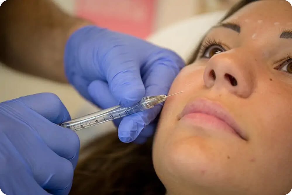 Filler Acido Ialuronico Filler Acido Ialuronico