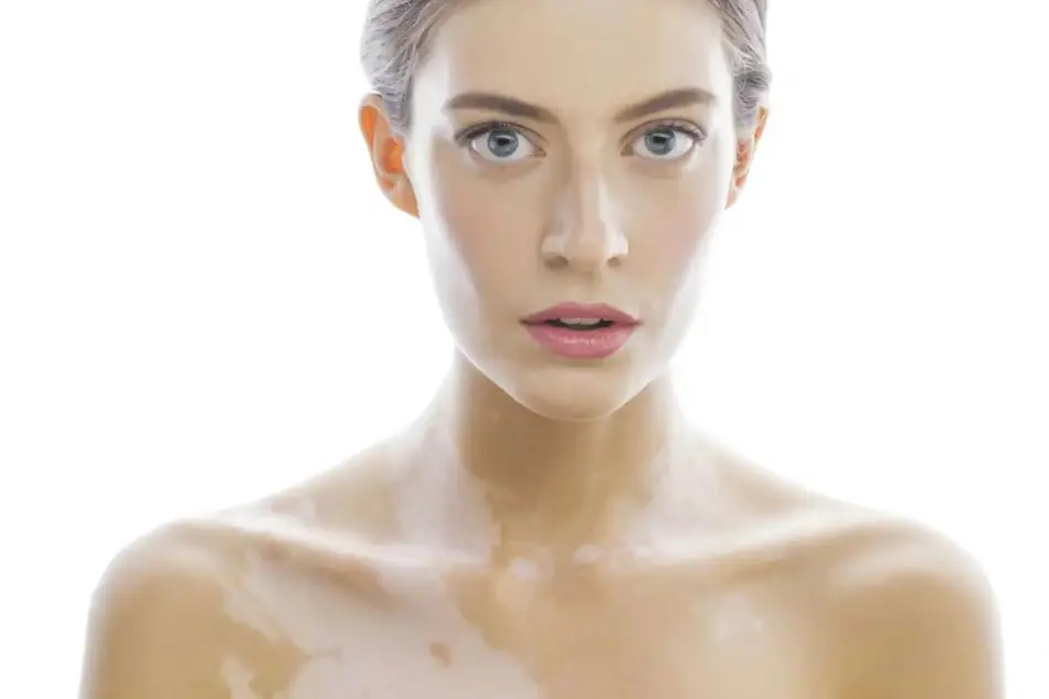 Vitiligine Cliniche La Grazia Bassano Vicenza