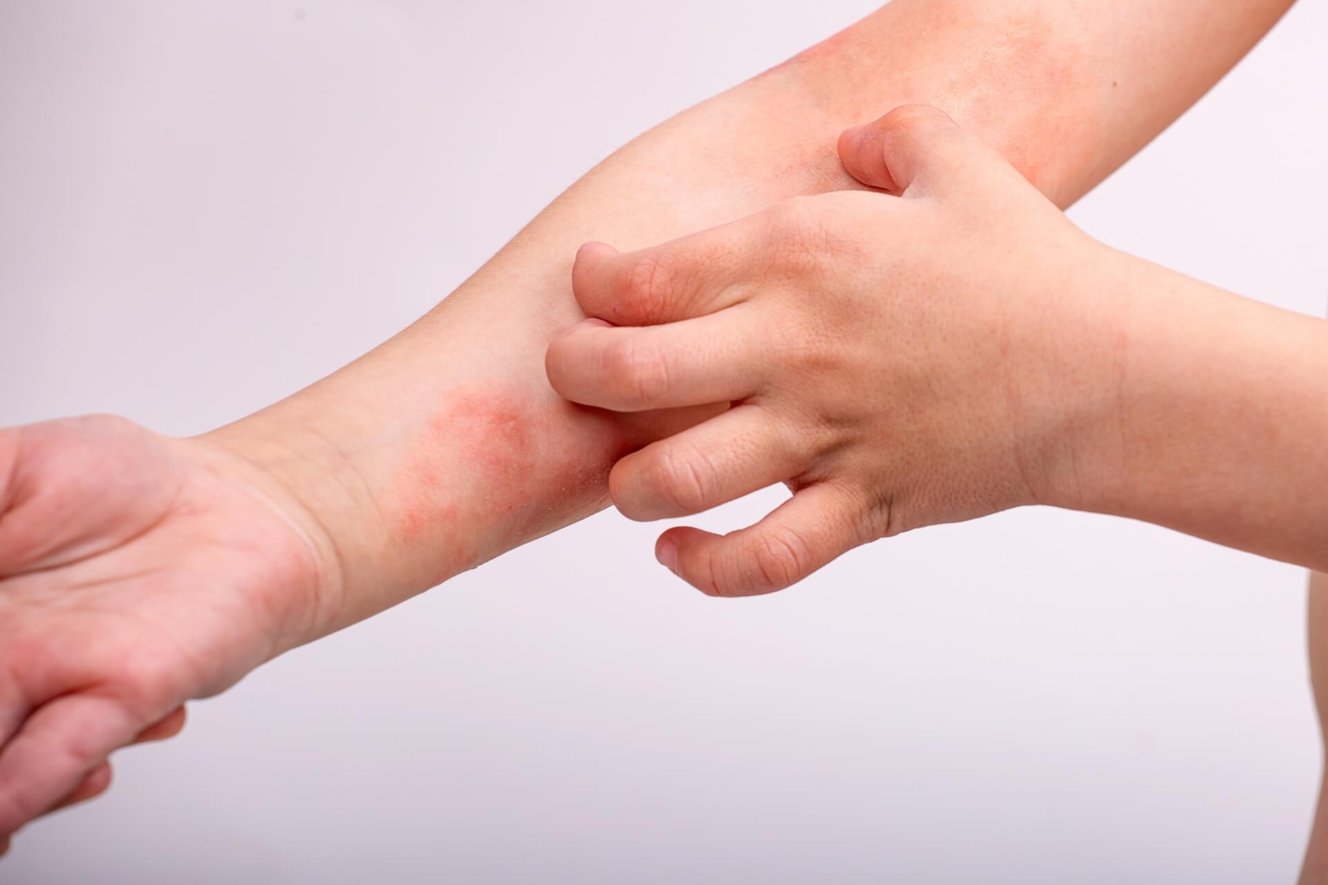 dermatite bambino cause e rimedi