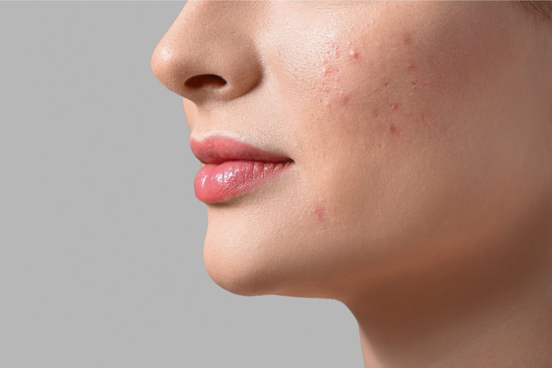 terapia acne bassano del grappa vicenza