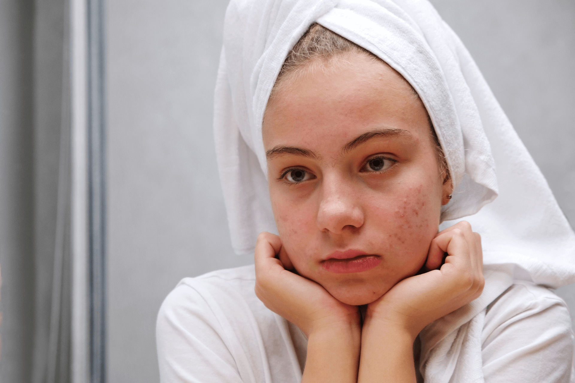 acne giovanile cura bassano vicenza