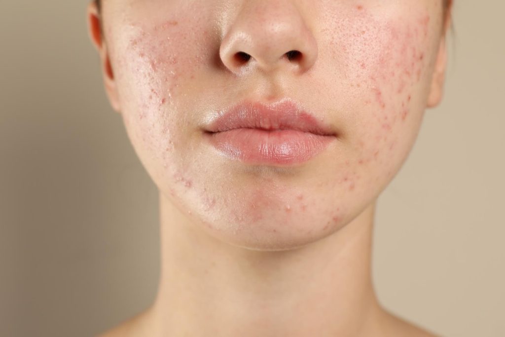 trattamento acne bassano vicenza